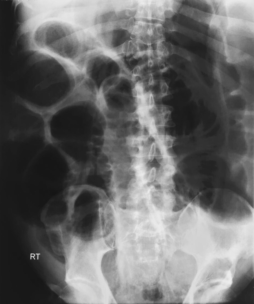 Male With Large Bowel Obstruction
