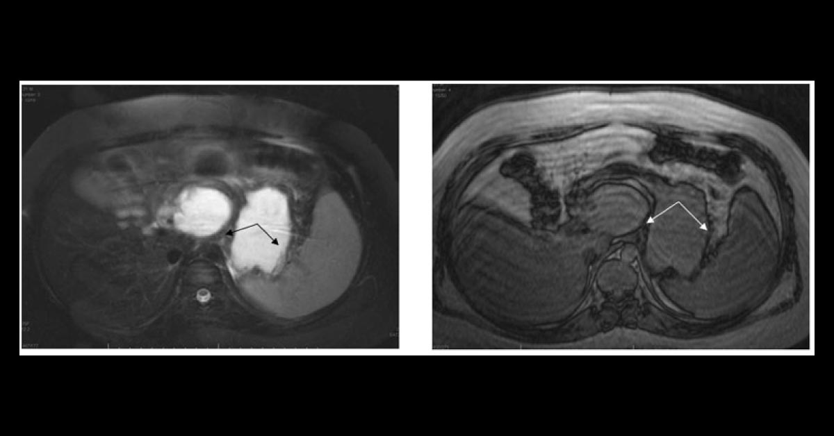 A Boy with Chronic Abdominal Pain and Vomiting