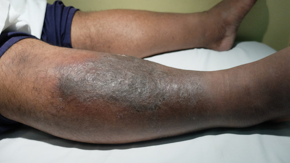 Anticoagulation For Deep Vein Thrombosis