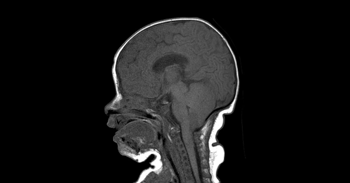 Diagnose This Neonate's Abnormality?