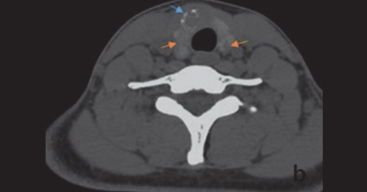 A Lump on the Thyroid Isthmus