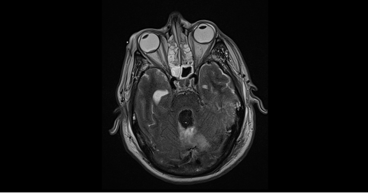 Interpret The MRI Scan?