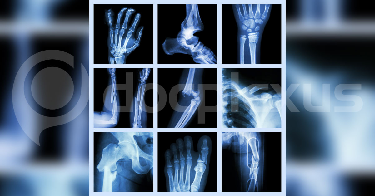 Glue Could Fix Broken Bones In Just 5 Minutes- A Revolutionary Research