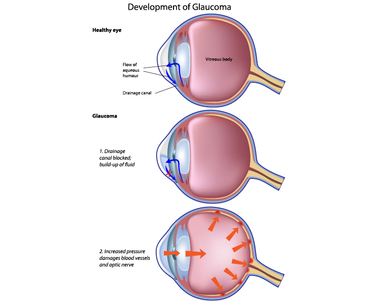 Brief Review Of Disc Changes In Glaucoma