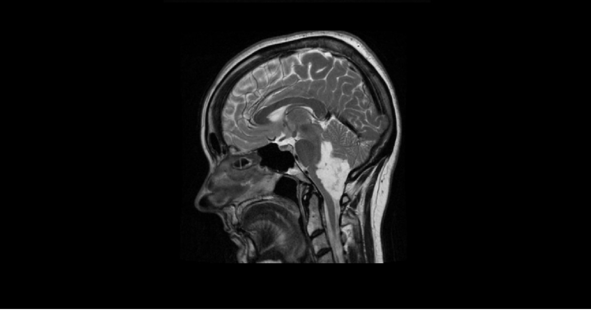 Diagnose This Neurology Case?