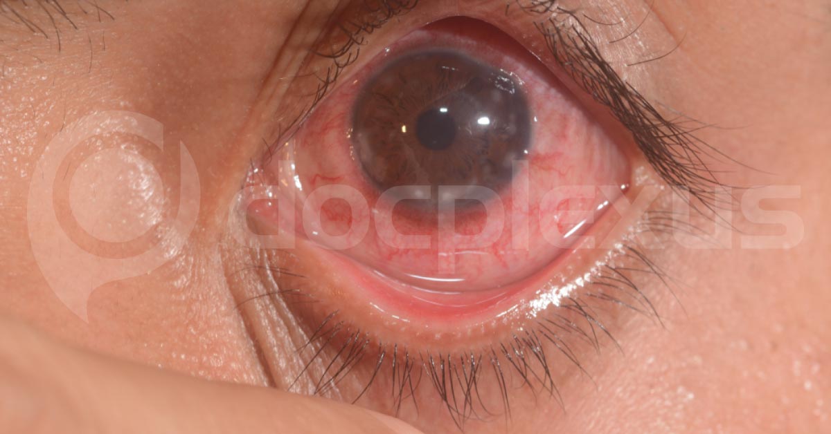 Present Day Treatment Of Vernal Keratoconjunctivitis