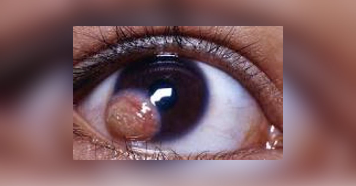 Brief Review On Atypical Manifestations Of Goldenhar Syndrome