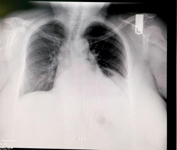 What Is This Chest X-ray Revealing?