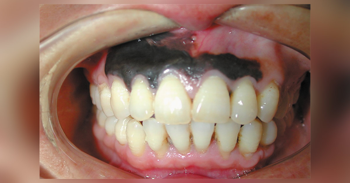 Darkening Of Gums