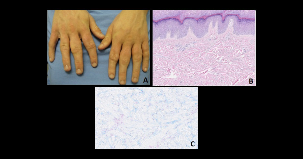 What is Your Diagnosis for This Man with Swollen Fingers?