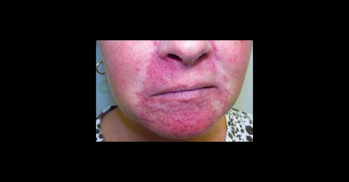 Female With Dermatitis Around Her Nose