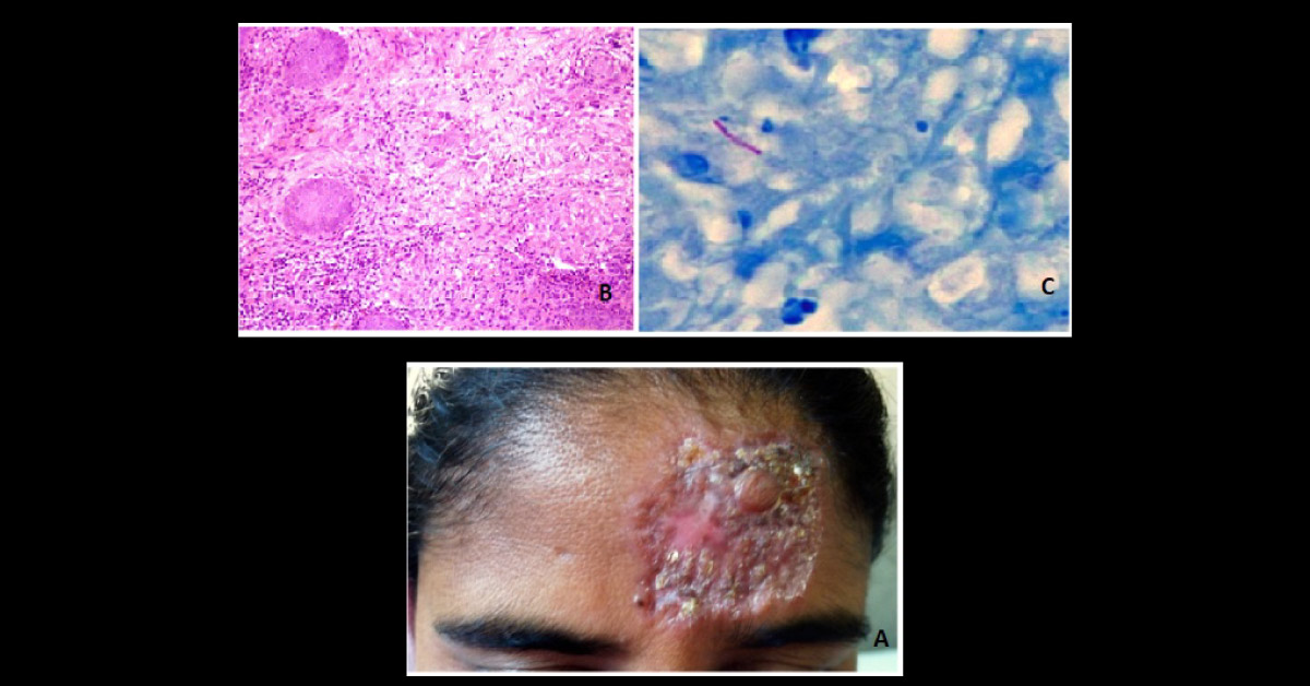 Woman with Lesion Following a Roadside Fall