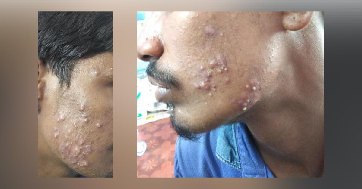 Suggest Management For These Pustules