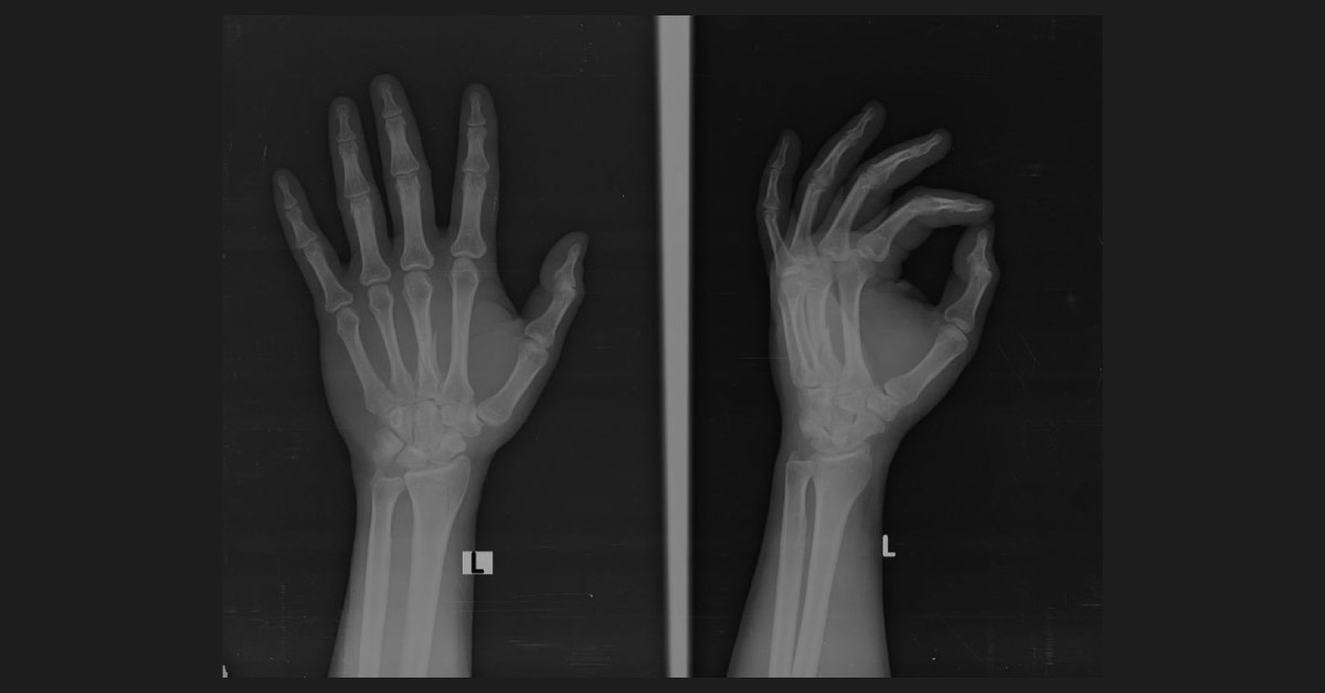 Identify The Type Of Fracture