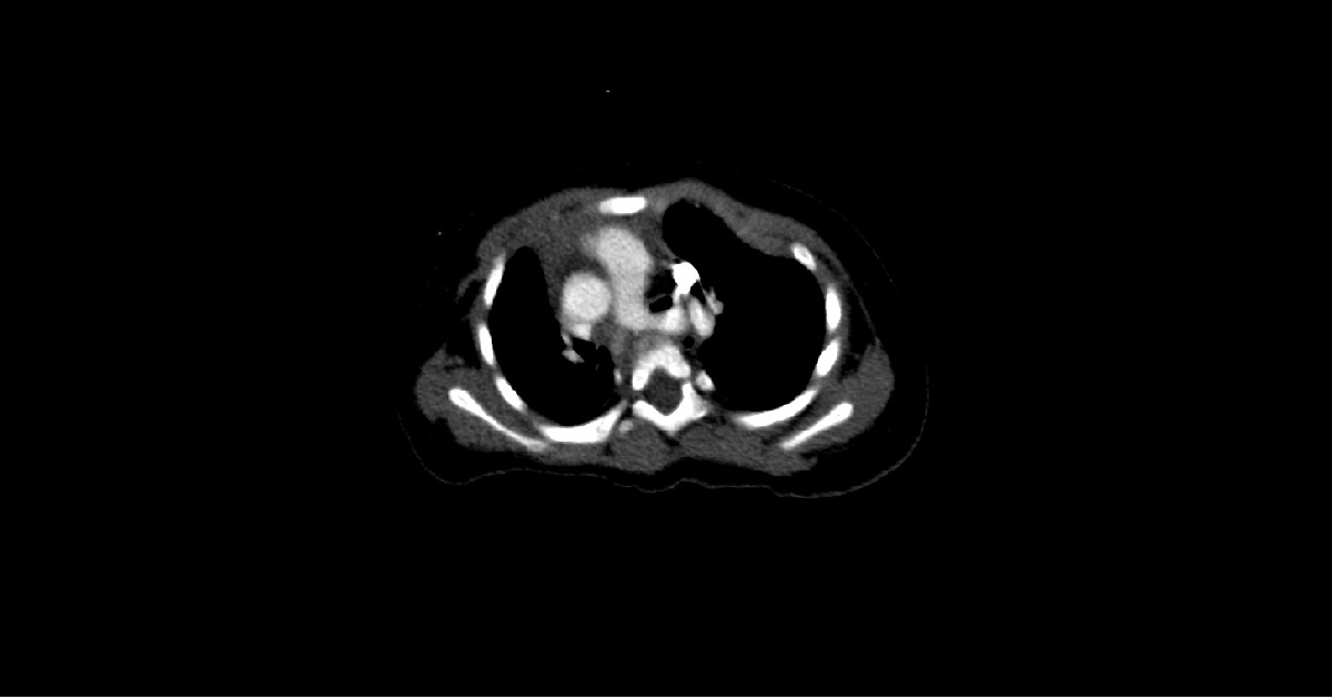 Spot the Pulmonary Abnormality?