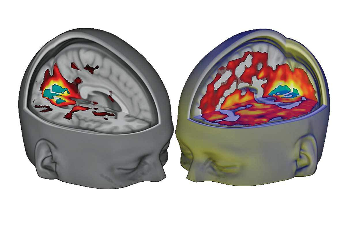 Modern Imaging Methods Are Revealing LSD’s Influence On The Brain