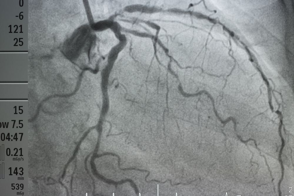 Left Main And Multi-Vessel Coronary Disease