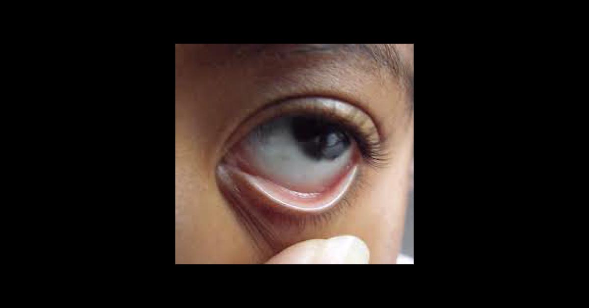 Ocular Manifestations Of Anemia Very Brief Review
