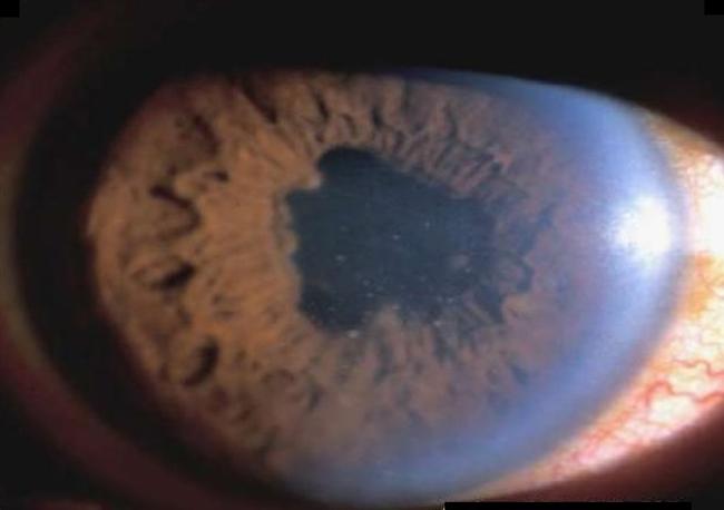 A Very Brief Review On Complications Of Uveitis