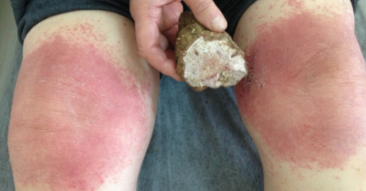 Man with Severe Skin Rashes
