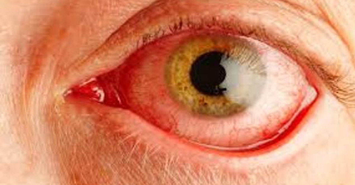 Brief Review On How To Proceed With Dry Eye Syndrome