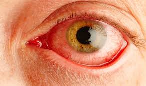 Brief Review On Presentations Of Allergic Conjunctivitis