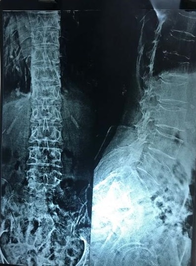 How Severe Is Osteoporosis In This X-Ray?