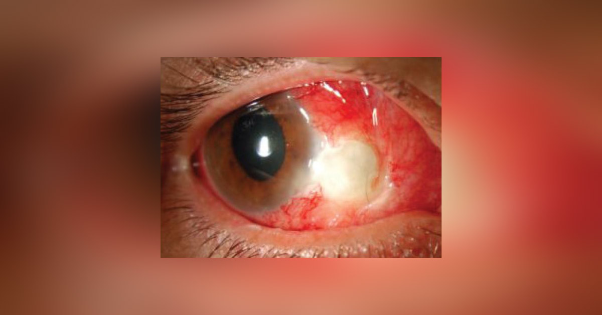 Complications Following Pterygium Surgery