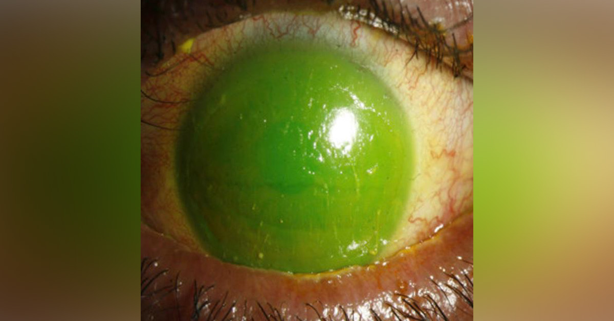 Brief Review Of Various Stains Used In Ophthalmic Practice