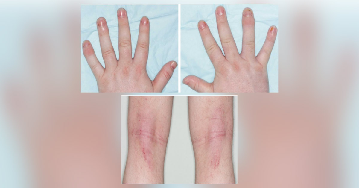 A Man with Recurrent Paronychia