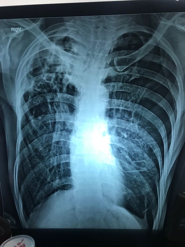Discuss This X-ray Chest! 