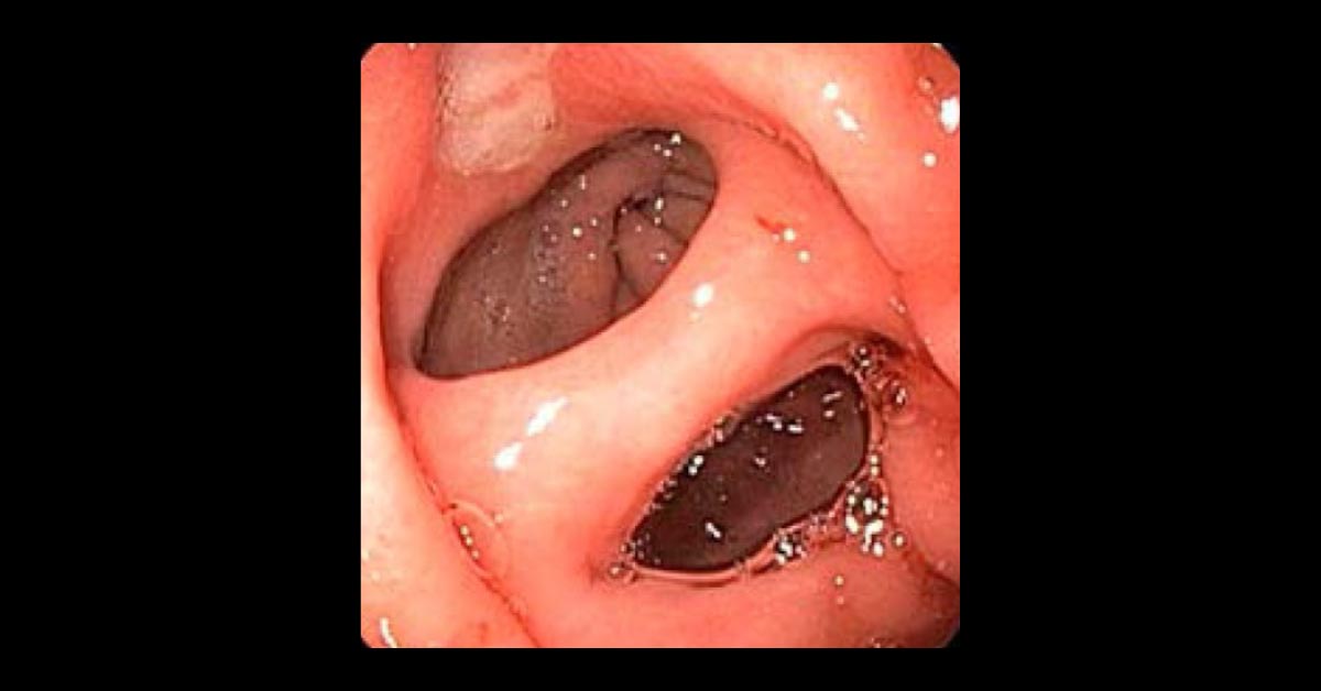 An Uncommon Complication Of Peptic Ulcer Disease