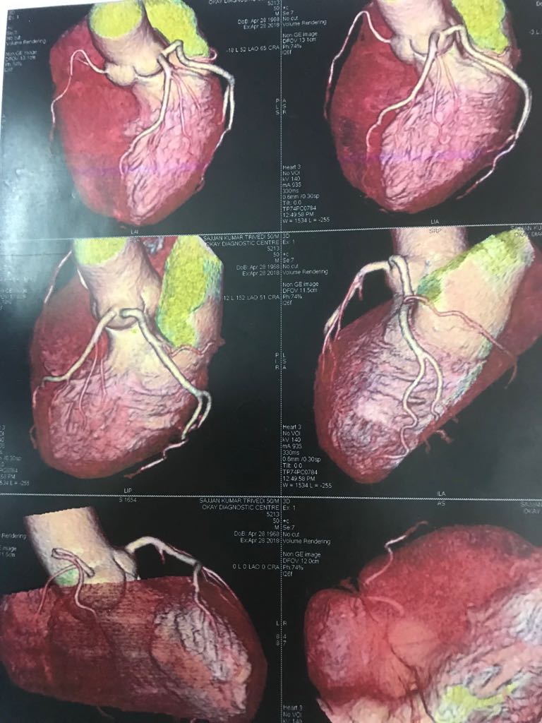 Where Is The Lt Coronary Artery? 