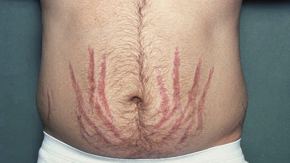 Identify the Reason Behind These Stretch Marks