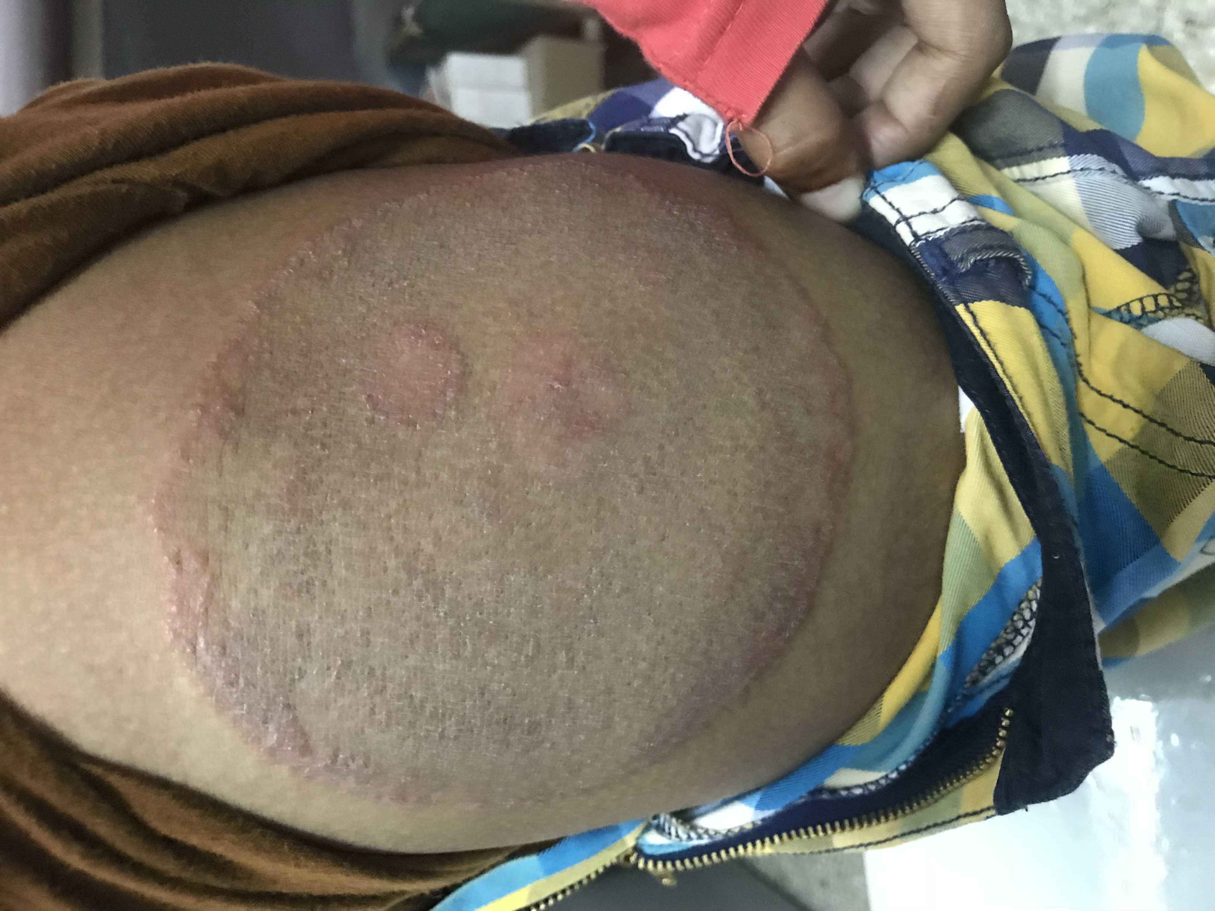 Is This A Super Fungal Infection Over The Main Infection?