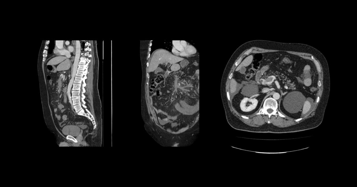 Male With Colicky Lower Abdominal Pain and Vomiting