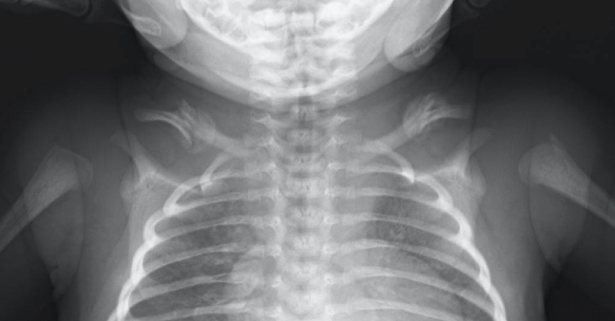 Case of a Macrosomic Infant with Shoulder Dystocia