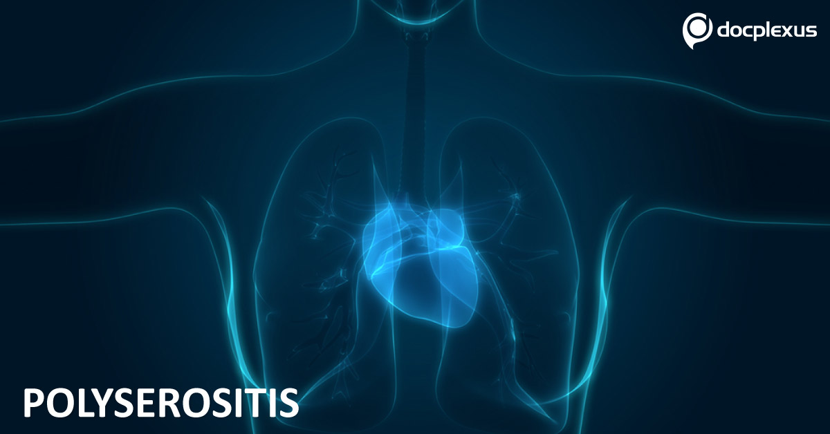 Identification and Management of Polyserositis