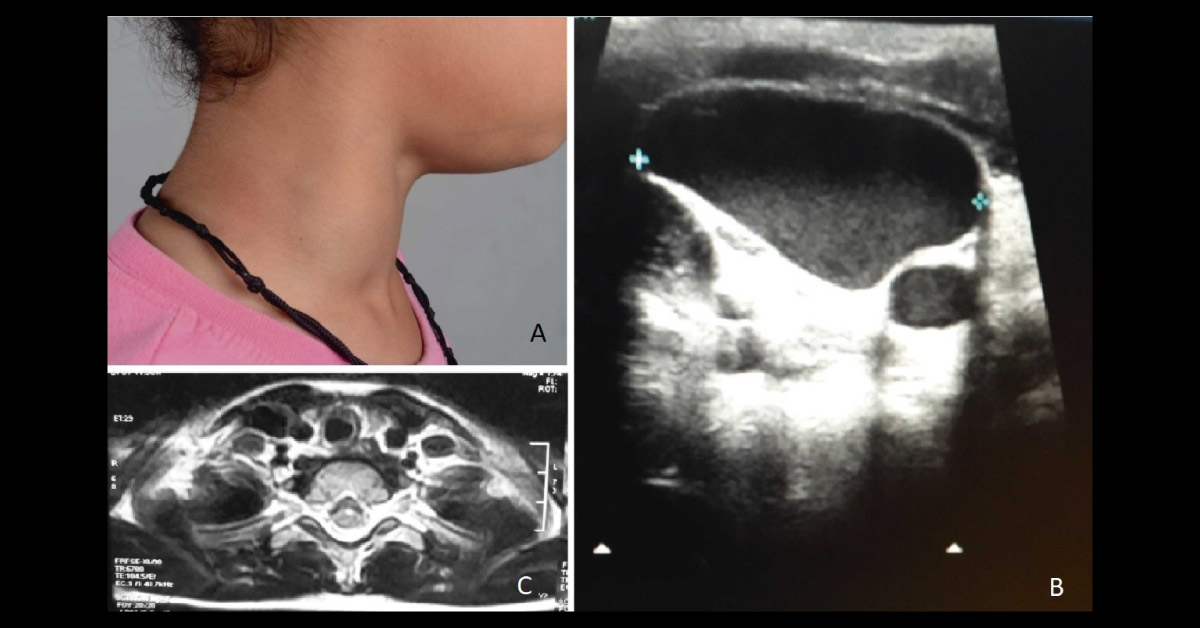 Case of a Young Boy with a Painless Lump on the Neck