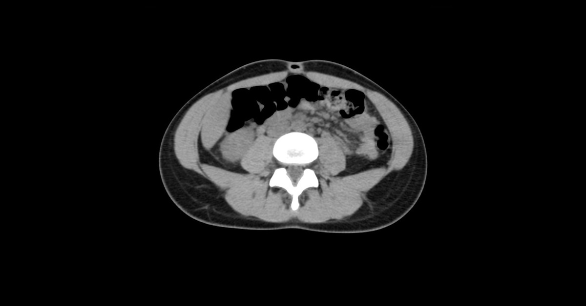 What Abnormality Do You Find In This CT Scan?