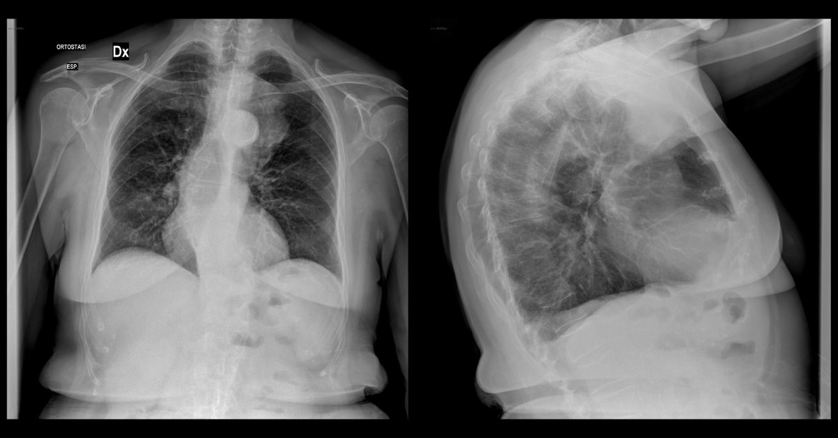 Old Lady With Chest Mass