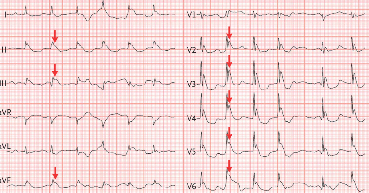 What Is Evident From Electrocardiogram?