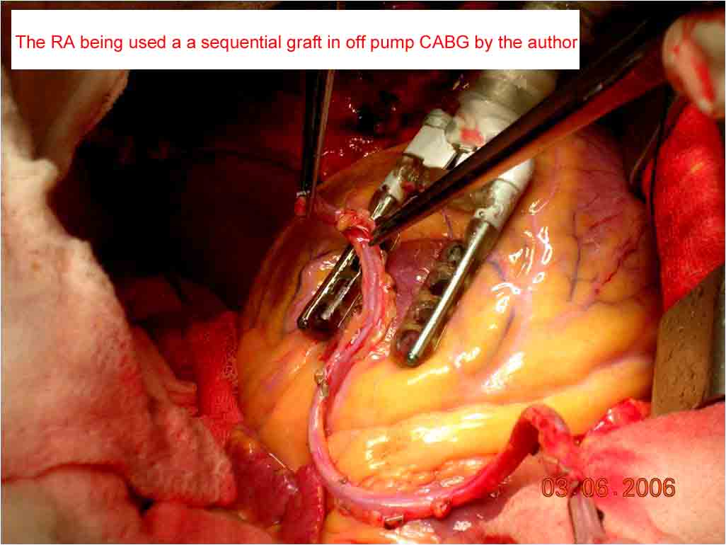 Radial Artery Is A Better Choice The Saphenous Vein As A Second Conduit