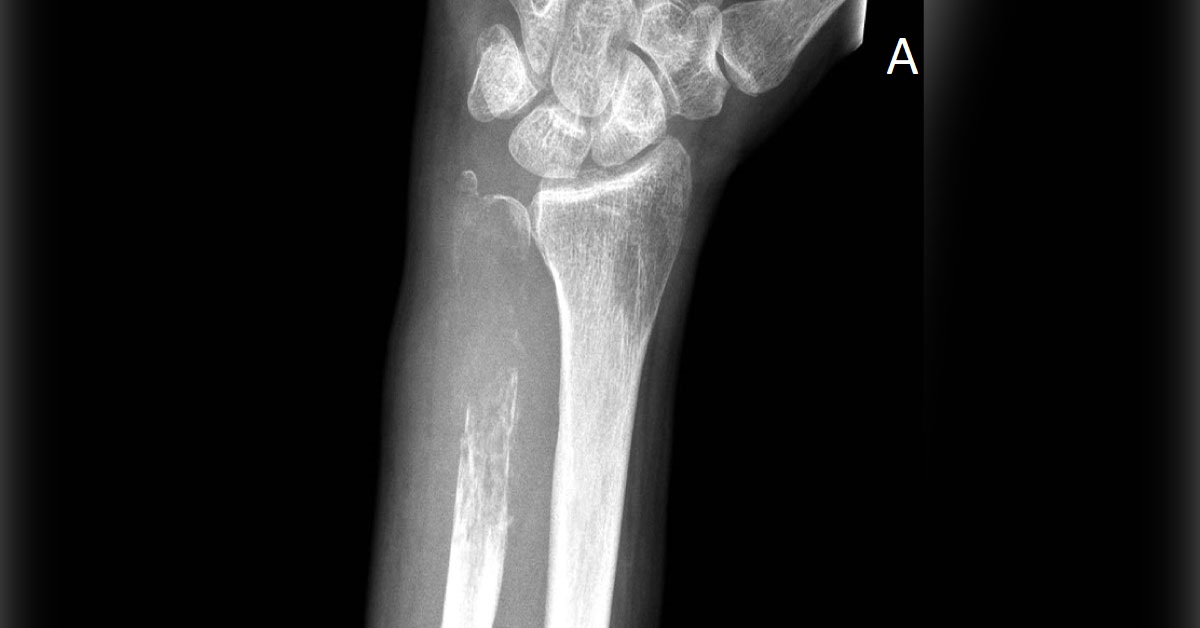 Vanishing Ulnae