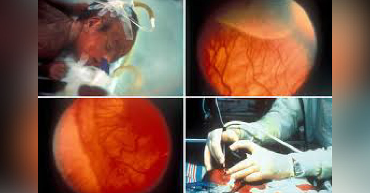Screening For Retinal Prematurity In Premature Children ROP