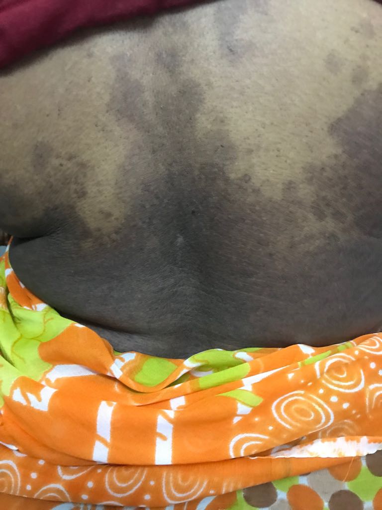 Suggest Treatment Extensive Psoriasis- Part II