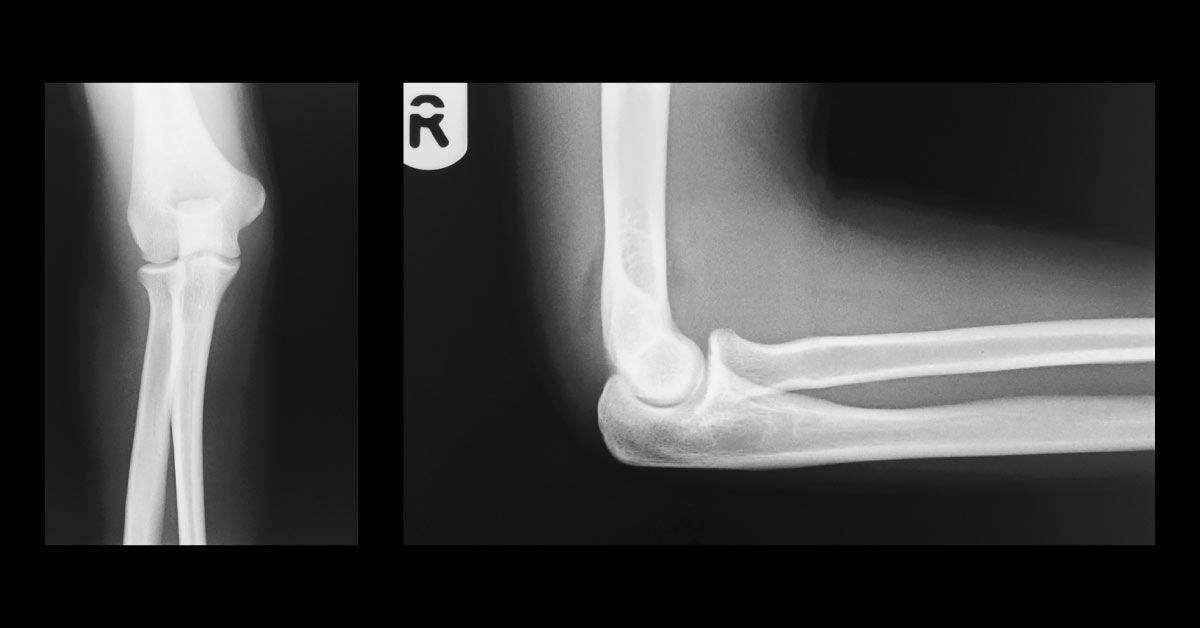 Soldier With Elbow Pain