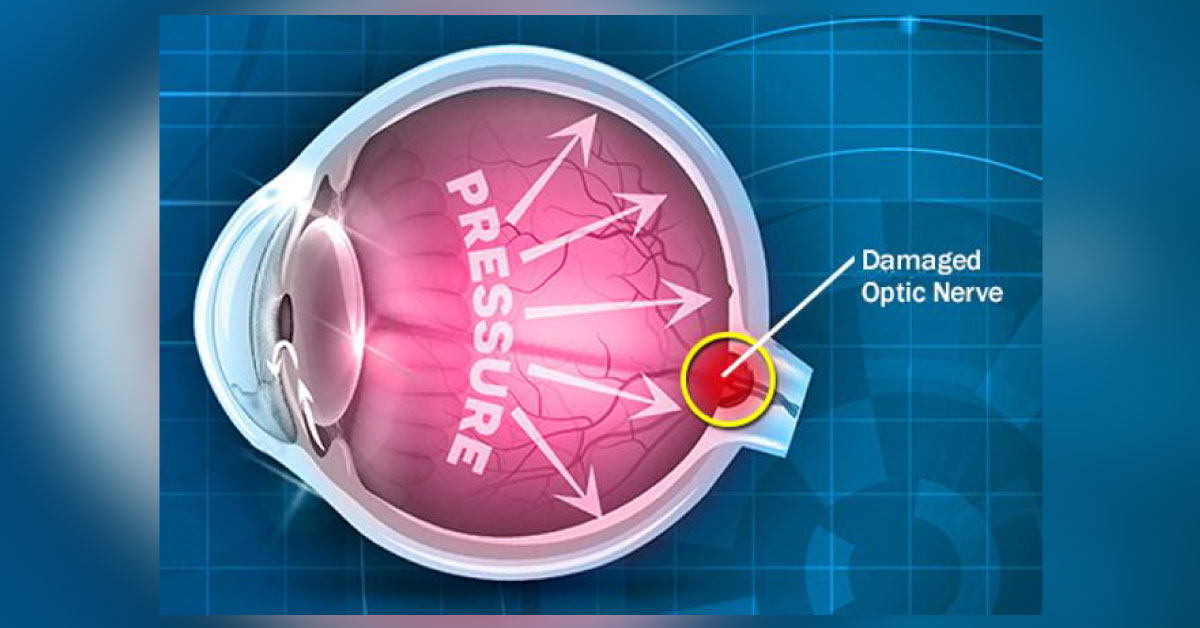 Classification Of Glaucoma