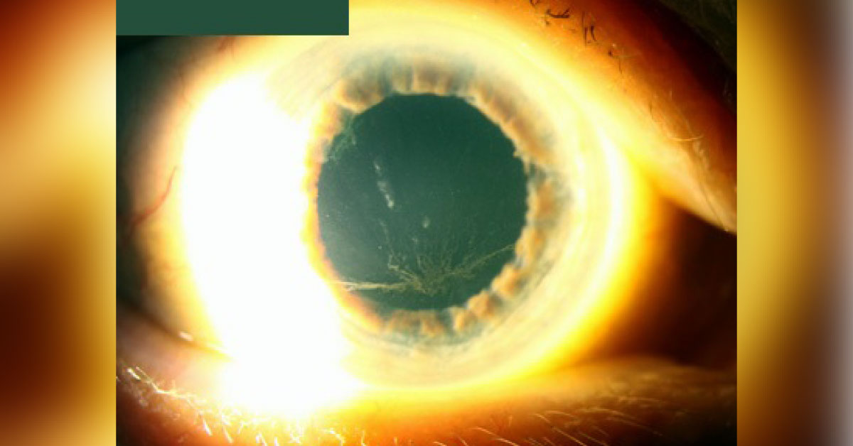 Identify This Ophthalmic Condition