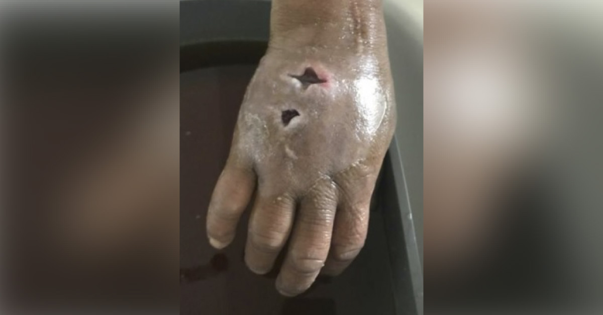 Severe Hand Infection in an Intravenous Drug Abuser